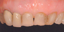 Протезирование зубов в Тамбове, ортопедия в г. Тамбове - стоматология Авонстом