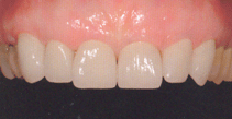 Протезирование зубов в Тамбове, ортопедия в г. Тамбове - стоматология Авонстом