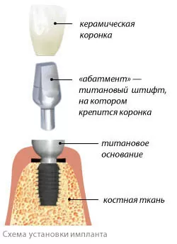 Схема установки импланта при иплантации зубов - стоматология Авонстом, г. Тамбов