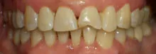До процедуры фотоотбеливания зубов в Тамбове - стоматология Авонстом