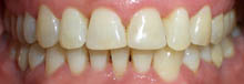 После процедуры отбеливания зубов в Тамбове - стоматология Авонстом